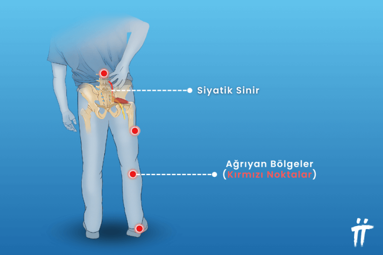 Siyatik Nedir Siyatik A R S Na Ne Yi Gelir Turan Turan