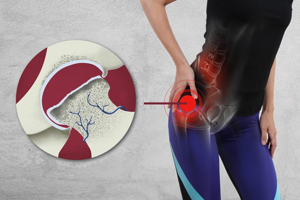 Kalça Avasküler Nekrozu Nedir? Belirtileri ve Tedavisi Nelerdir?
