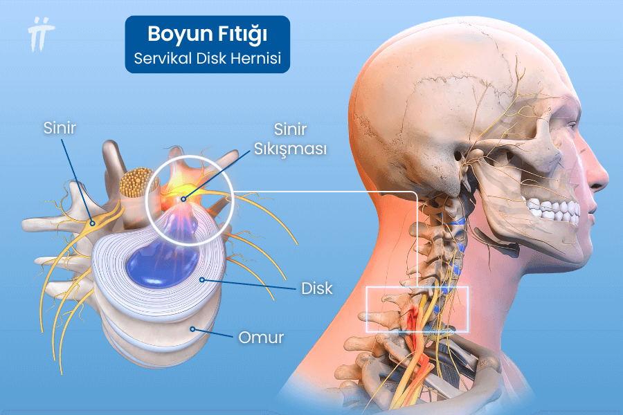 boyun fıtığı nedir nerede görünür