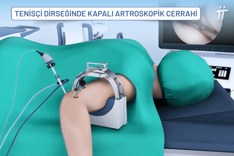  Tenisçi Dirseğinde Artroskopik Cerrahi Görüntüsü