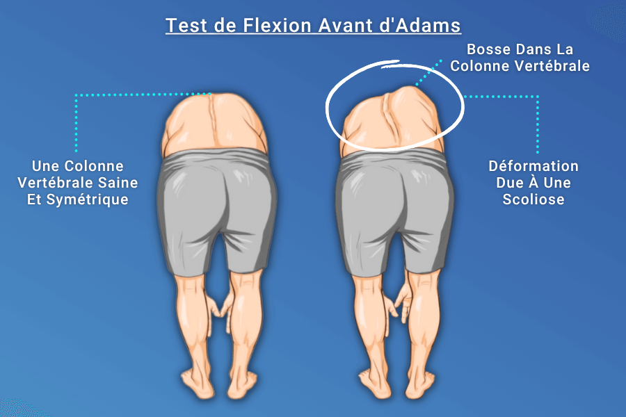 Différence de hauteur observée entre les régions dorsales droite et gauche pendant le test (déformation de la bosse).
