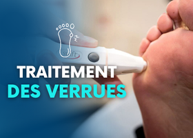Traitement des verrues