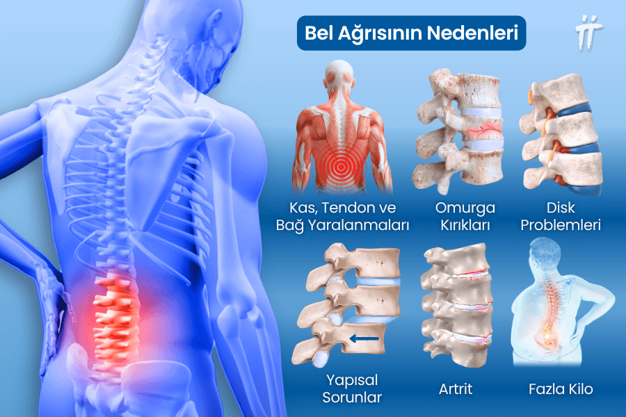 bel ağrısı neden olur?