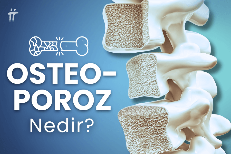 Osteoporoz, yani kemik erimesi, kemik mineral yoğunluğunun azalmasıyla kırılganlığa yol açan ciddi bir sağlık sorunudur.