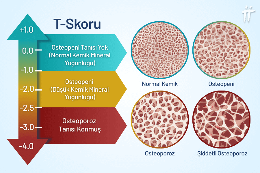Kemik yoğunluğu taramasında elde edilen T-skoru, osteoporoz ve osteopeni ayrımında belirleyicidir.
