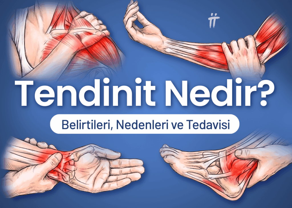 tendinit nedir