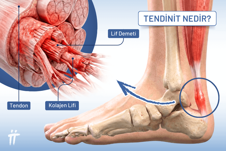 Kas gücünü kemiklere ileten tendonların iltihaplanması, günlük yaşamı zorlaştıran bir tendon ağrısı ve hassasiyet oluşturur.