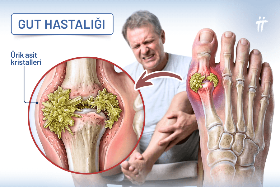 Eklemlerde biriken ürik asit kristalleri, aniden başlayan şiddetli bir ayak ağrısı şikayetine neden olur.