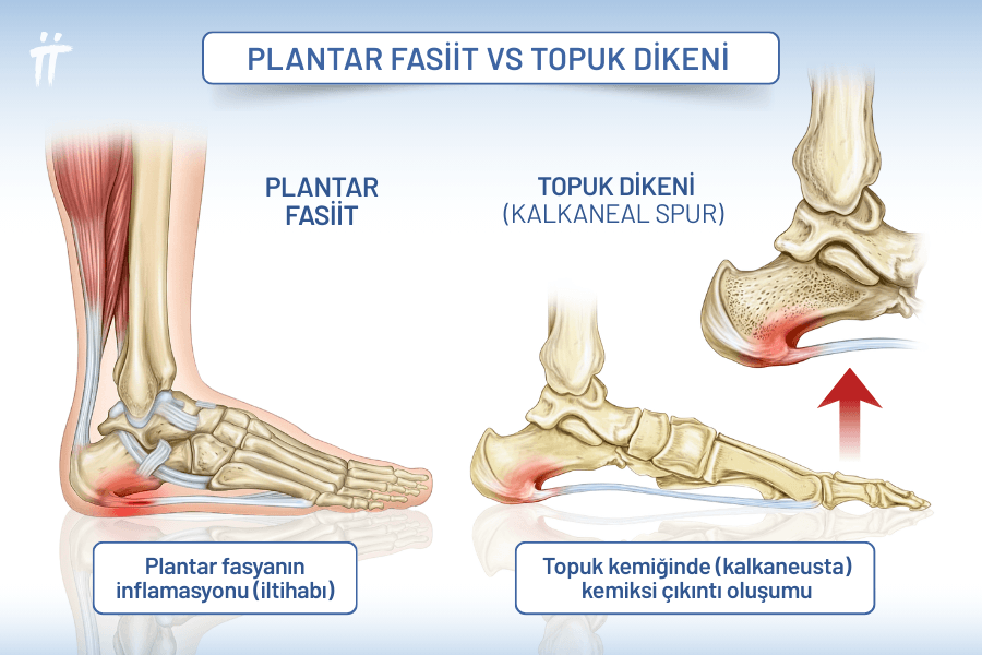 Ayak tabanındaki doku bandının iltihaplanması olan plantar fasiit, zamanla kemik üzerinde topuk dikeni adı verilen yapıların oluşmasına neden olabilir.