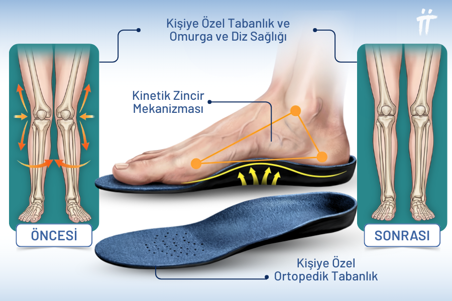 Ayak tabanından başlayarak tüm iskelet sistemini dengeleyen kişiye özel ortopedik tabanlık, kinetik zincir mekanizması sayesinde diz ve omurga sağlığını korumaya destek olur.
