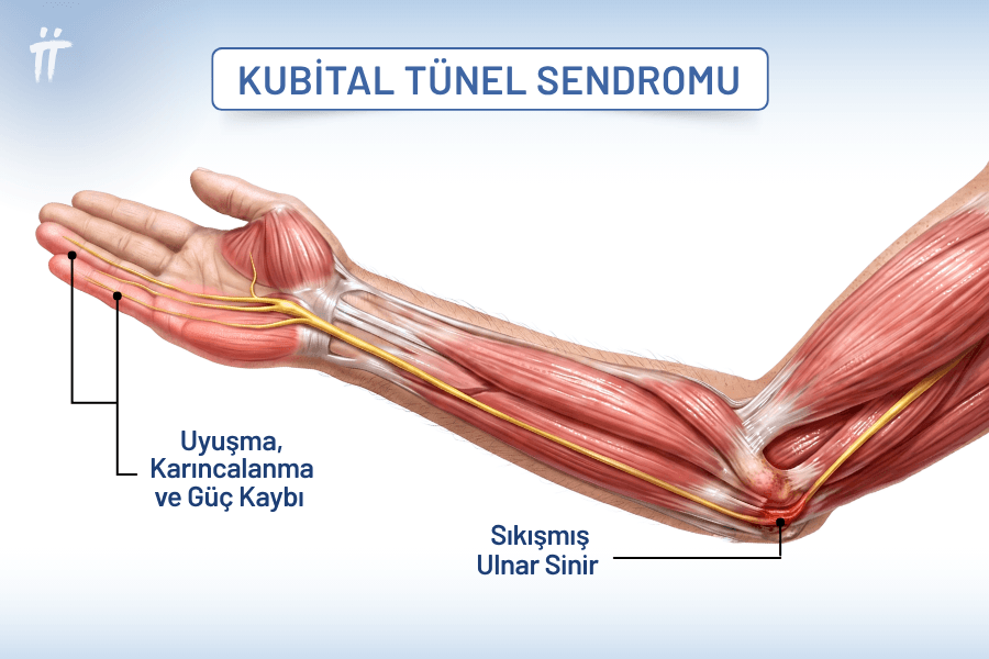 Kübital tünel sendromu, dirsek iç kısmındaki ulnar sinirin sıkışmasıdır.