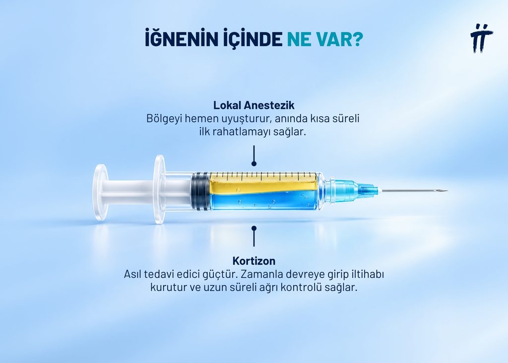 Kortizon iğnesi, kortizon ilacının doğrudan ağrıyan bölgeye, örneğin ekleme ya da tendon çevresine yapılmasıdır.