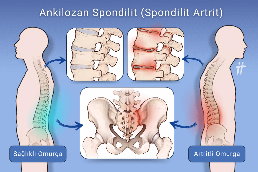 Ankilozan Spondilit (Spondilit Artrit)