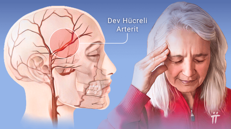 Dev hücreli arterit (Temporal Arterit) görünümü.