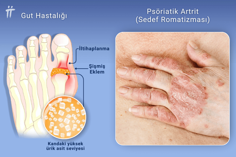 Gut Hastalığı - Psöriatik Artrit ( Sedef Romatizması)
