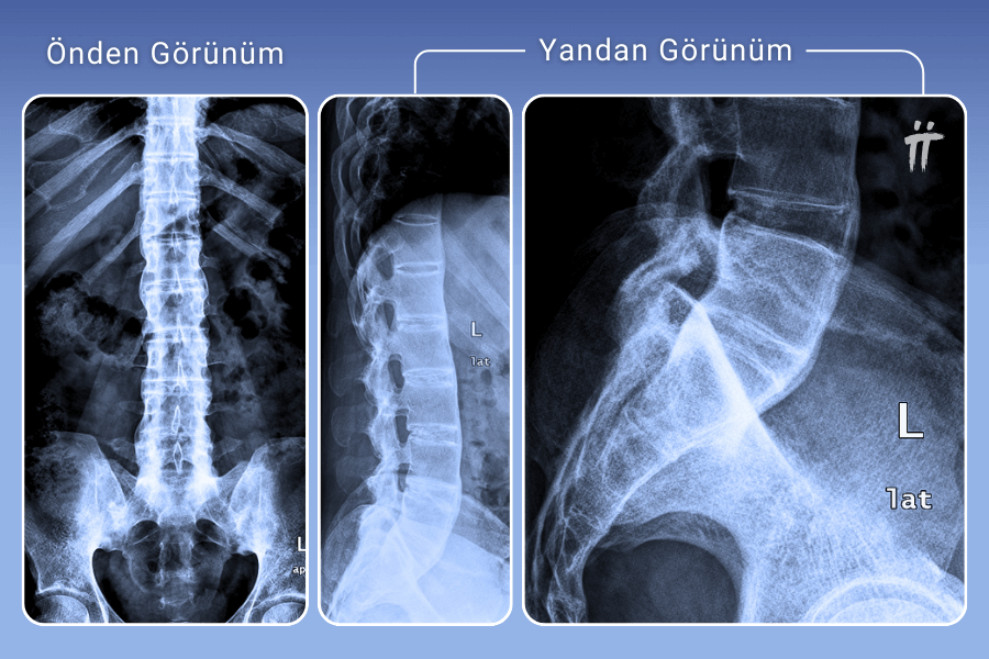 Lomber omurgada ankilozan spondilit kaynaklı omurların birbiriyle kaynaşmasını gösteren röntgen filmi.