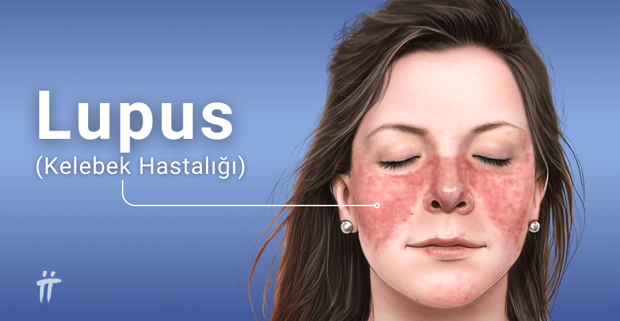 Lupus (Kelebek Hastalığı)