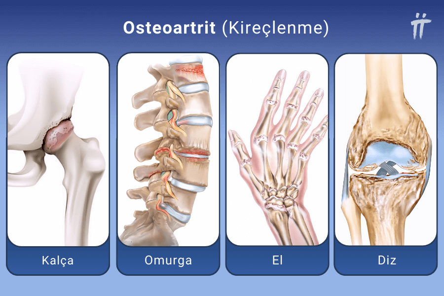 Osteoartrit (Kireçlenme)