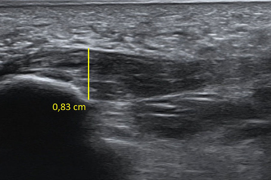 Topuk Dikeni ultrason görüntüsü