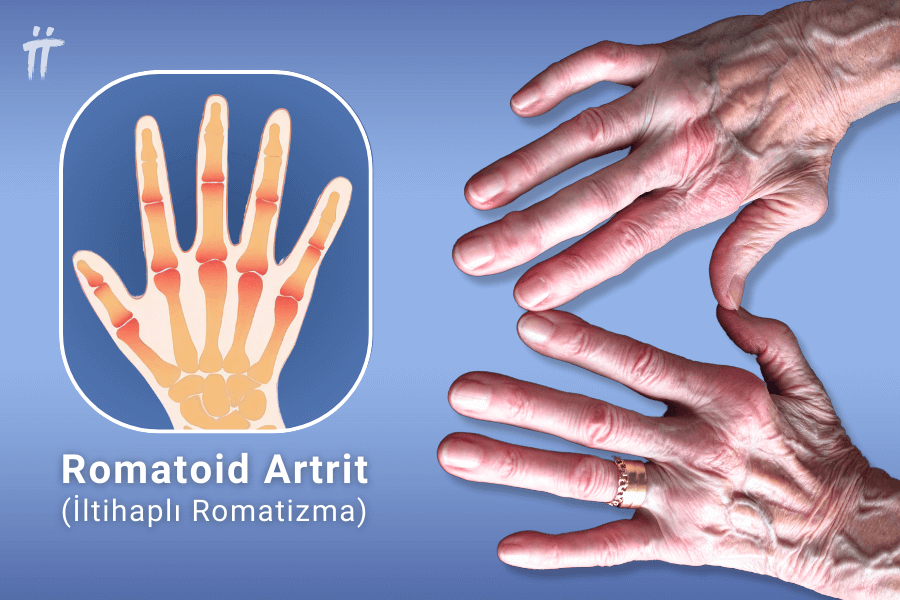 Romatoid Artrit (İltihaplı Romatizma)