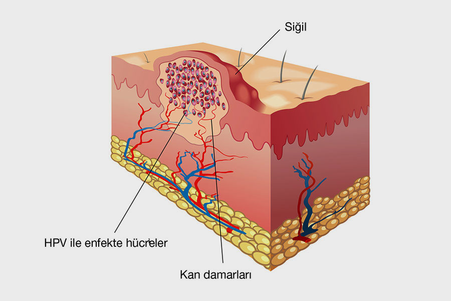 HPV virüsünün deride enfekte ettiği hücreler