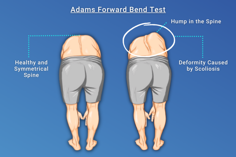 Scoliosis Exercises and Schroth Method - Turan&Turan