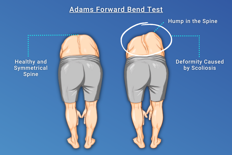 adams forward bend test Height difference between the right and left back during the test (hump deformity)