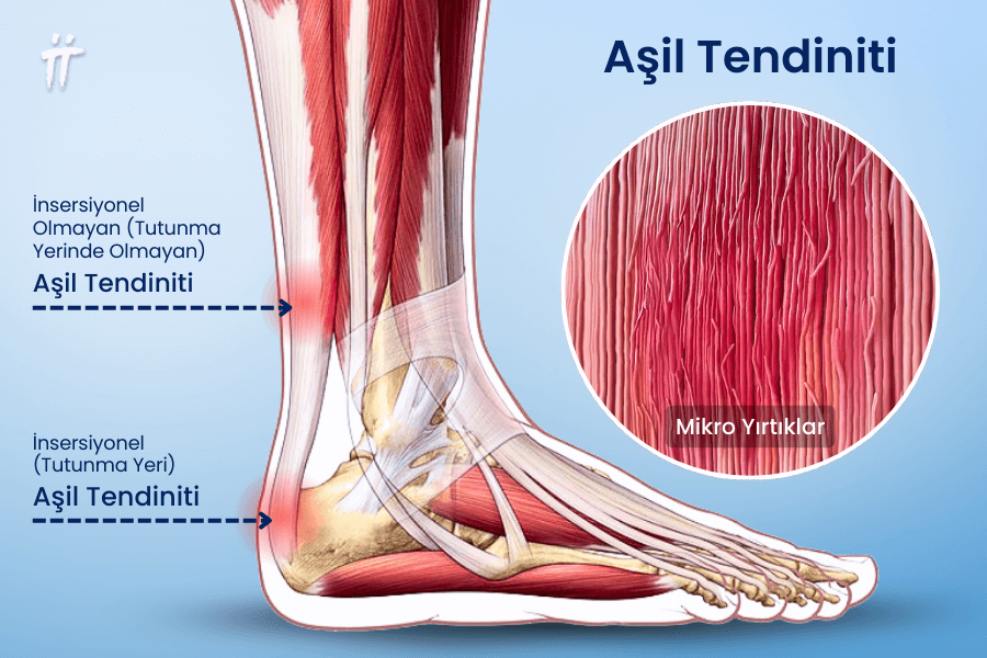  Tendonun aşırı kullanımıyla ortaya çıkan Aşil tendiniti, topuk arkasında hissedilen Aşil tendonu ağrısının en yaygın nedenlerinden biridir.