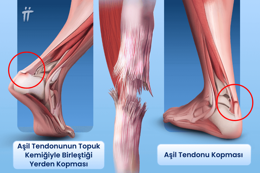 Spor sırasında veya beklenmedik kazalarla gelişebilen Aşil tendonu kopması