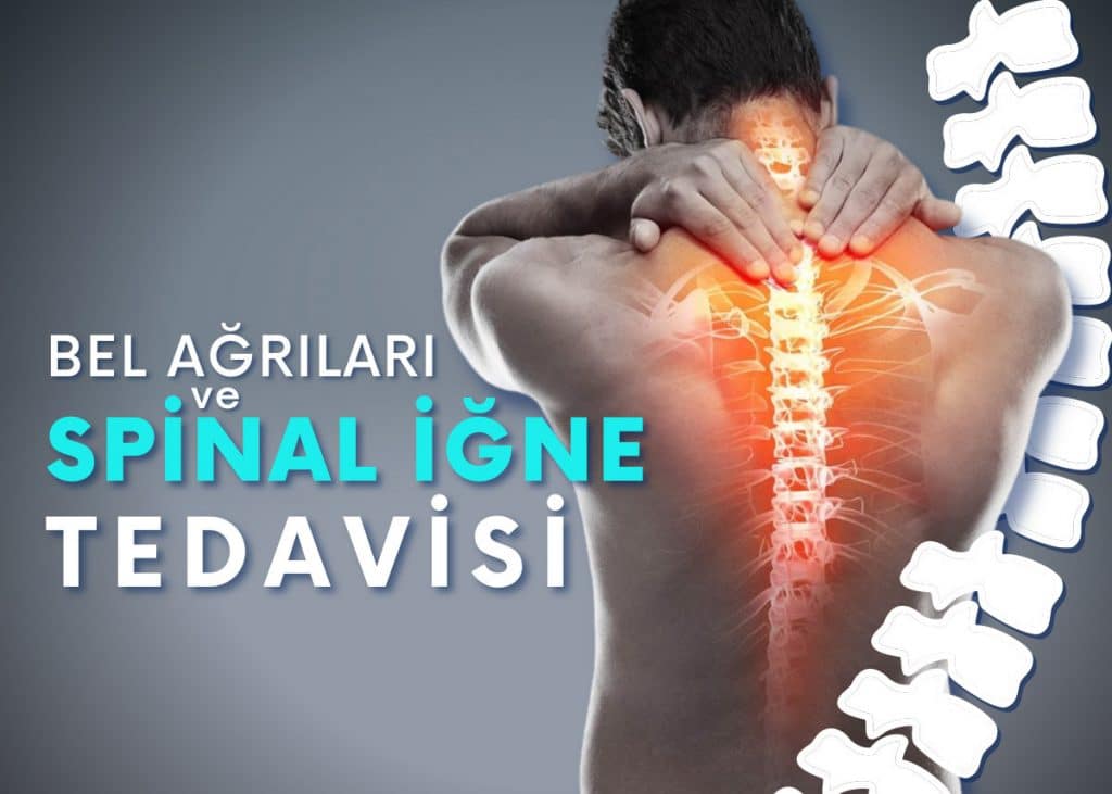 Tekrarlayan Bel Ağrıları İçin Spinal İğnesi Tedavisi