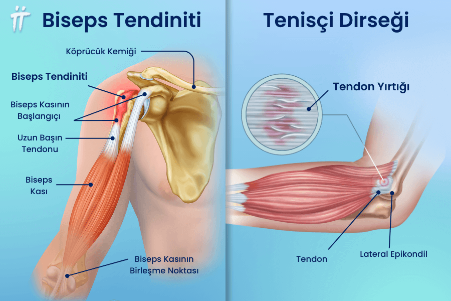 Biceps tendiniti, yayılan kol ağrısına neden olabilir.