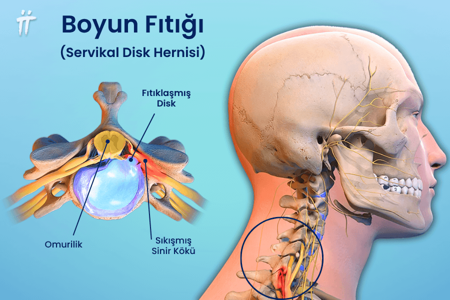 Boyun fıtığı, sinirlere baskı yaparak kol ağrısına yol açabilir.