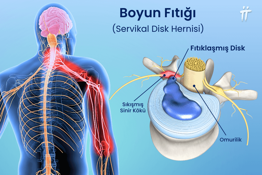 Boyun omurları arasındaki diskin yerinden taşarak sinir köküne baskı yapmasıyla oluşan boyun fıtığı, sorunun kaynağı boyun olmasına rağmen kola yayılan bir dirsek ağrısı nedeni olabilir.