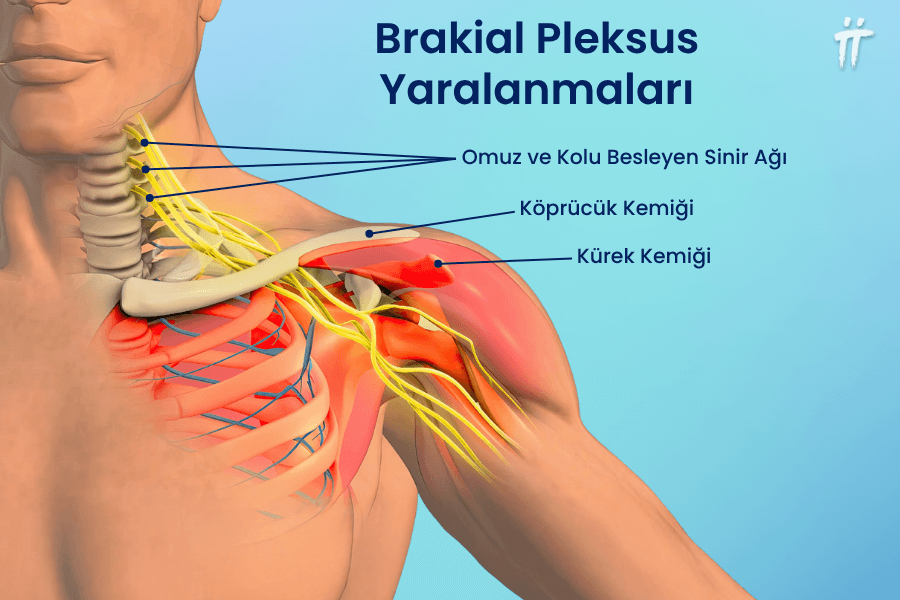 Brakial pleksus yaralanmaları, genellikle darbelere bağlı olarak kol ağrısına yol açabilir.
