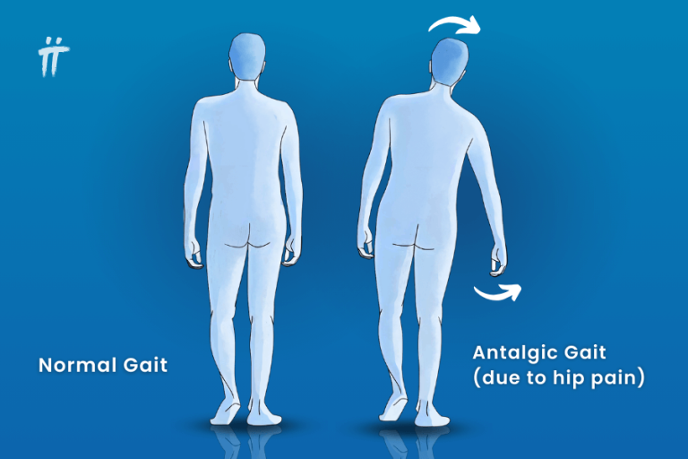 What is Gait Disorder and Why Does It Occur? Turan&Turan