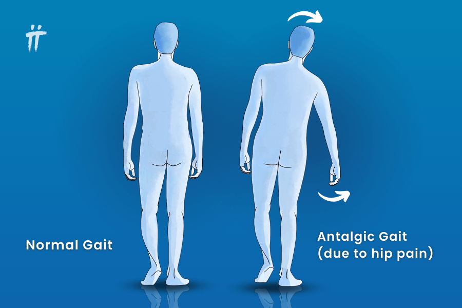 Coxalgic (due to hip pain) gait type