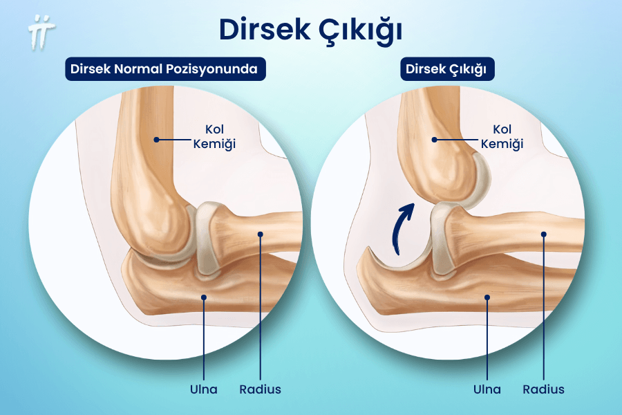 Dirsek çıkığı nasıl anlaşılır​?