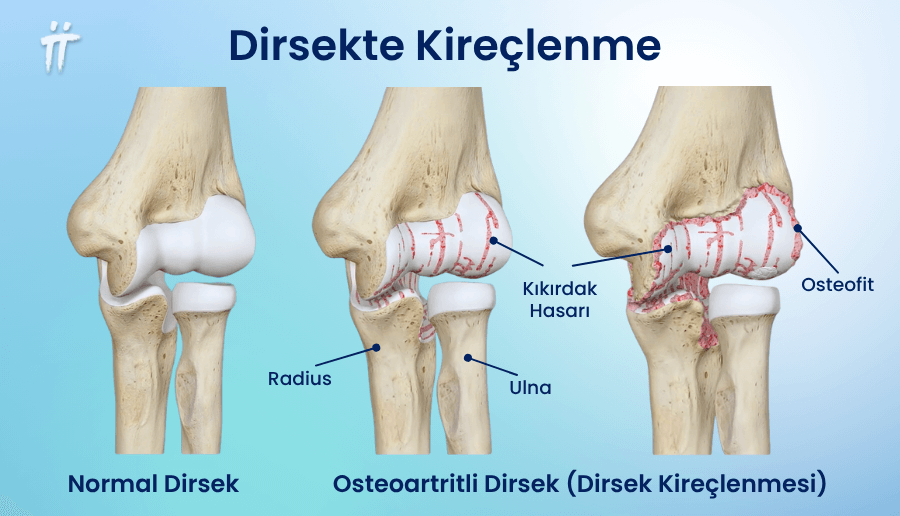 Dirsek kireçlenmesi