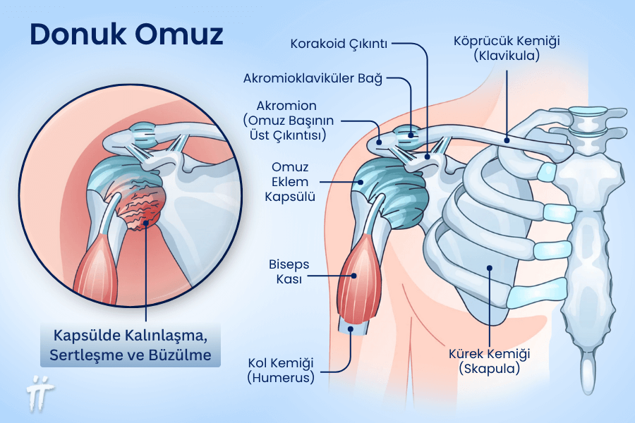 Donuk omuz, omuz ve kol ağrısının yaygın nedenlerinden biridir.