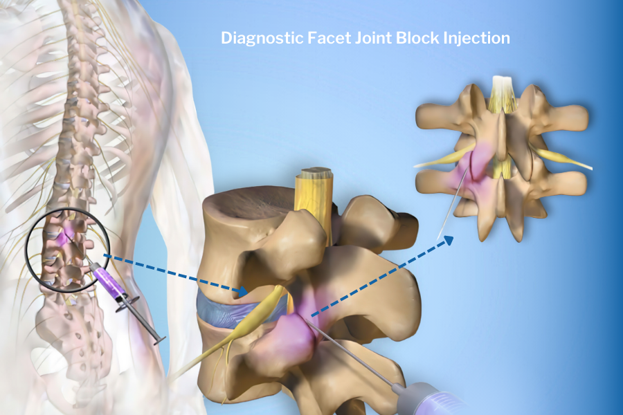  Diagnostic facet joint block injection
