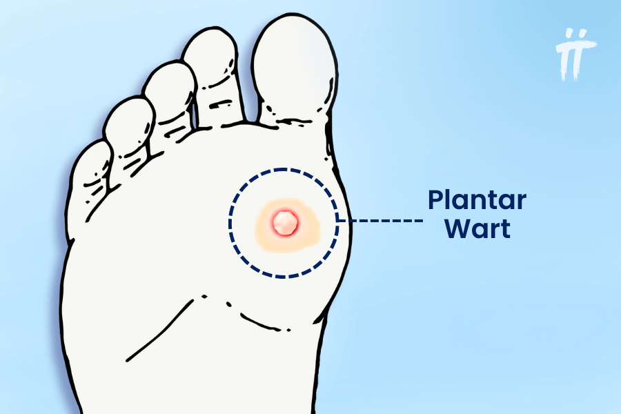 foot sole wart treatment