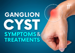 ganglion cyst symptoms