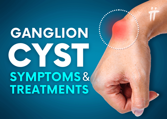 Ganglion Cyst Symptoms and Treatment Methods Turan&Turan