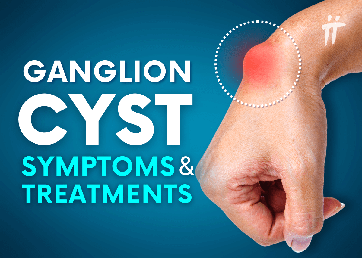 Ganglion Cyst: Symptoms and Treatment Methods - Turan&Turan