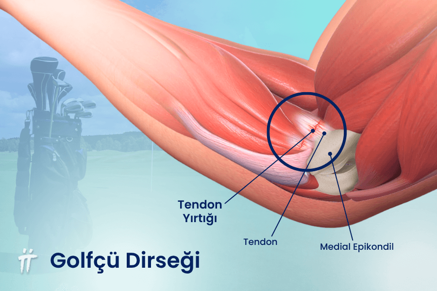 Dirseğin iç kısmındaki tendonların aşırı kullanımıyla oluşan golfçü dirseği, ağır kaldırınca dirsek ağrısı şikayetine neden olur.