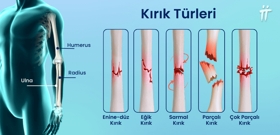 Kol kemikleri kırıldığında, kol ağrısı en sık görülen belirtilerden biridir.
