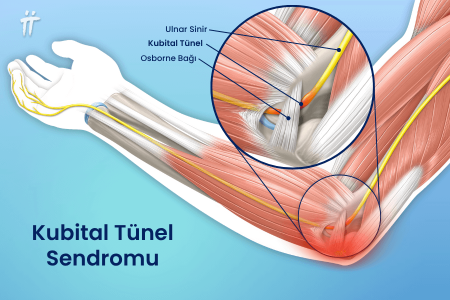 Ulnar sinir, sıkışmaya bağlı olarak kubital tünel sendromuna yatkındır.