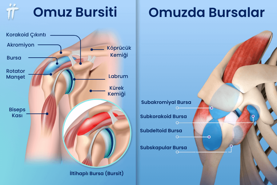 Omuz (subakromiyal) ve dirsek (olekranon) bursalarının iltihaplanması, kol ve eklem ağrısına neden olabilir.
