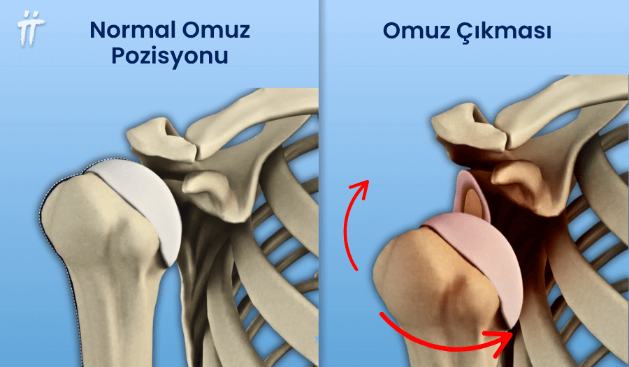 Omuz çıkması, geçmeyen omuz ağrısına neden olabilir.