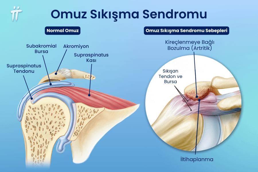 İmpingement sendromu (omuz sıkışma sendromu), hareketle artan kol ağrısına neden olabilir.